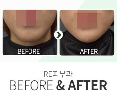 비포애프터